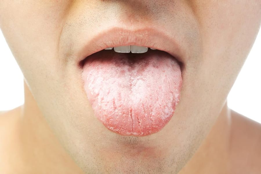 Qué revela la lengua sobre tu salud: señales que pueden indicar anemia, diabetes o cáncer
