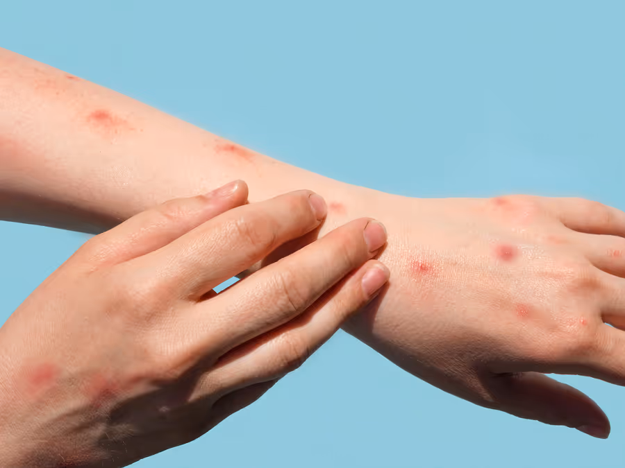 Nueva York identifica primer caso de cepa grave de Mpox en un viajero